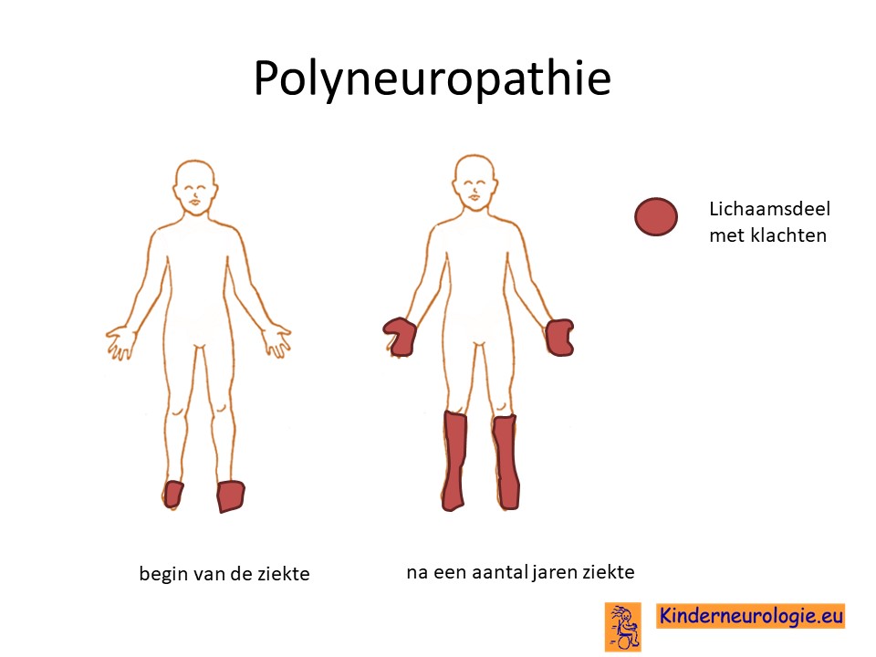 polyneuropathie